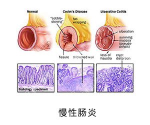 要拉屎的时候肚子绞痛是什么原理_什么拉屎的时候会出血